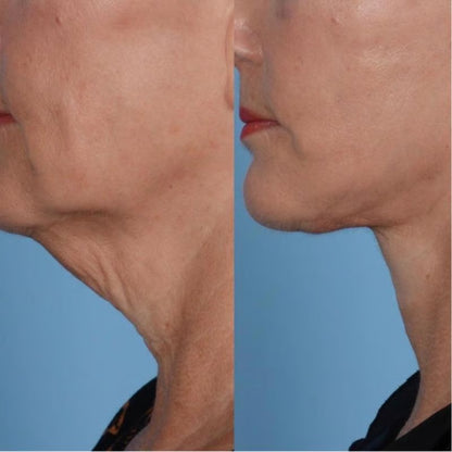 💜Official Authorized |🔥Neck Care Stick, Oil-nourishing, Firming & Lifting Firming Neck Cream